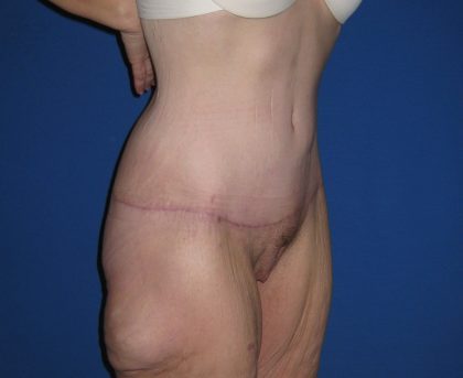 Extended Tummy Tuck Before & After Patient #4237