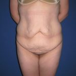 Extended Tummy Tuck Before & After Patient #4230