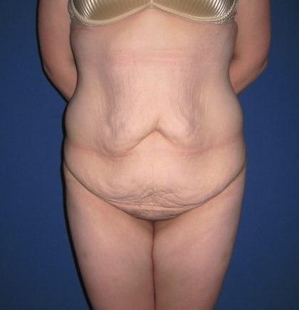 Extended Tummy Tuck Before & After Patient #4230