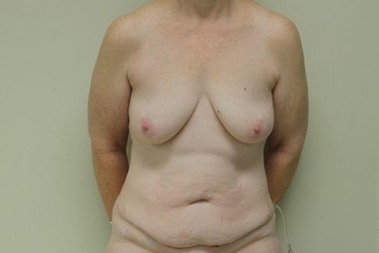 Breast Augmentation with Lift Before & After Patient #4265