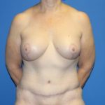 Breast Augmentation with Lift Before & After Patient #4265