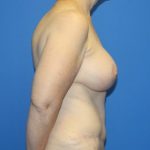 Breast Augmentation with Lift Before & After Patient #4265