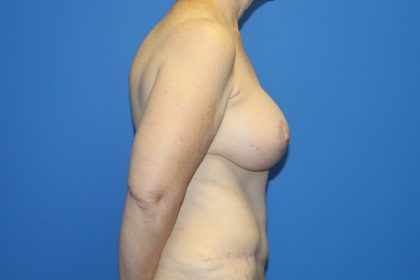 Breast Augmentation with Lift Before & After Patient #4265