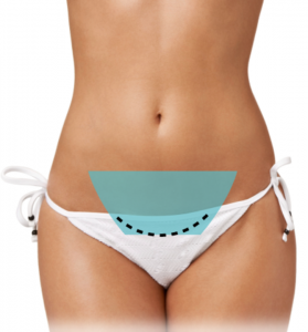 mini tummy tuck