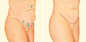 tummy tuck maryland