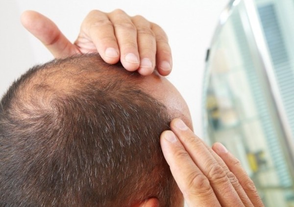 Hair loss treatment prp