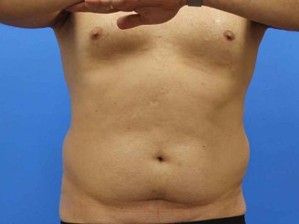 Liposuction Before & After Patient #5469