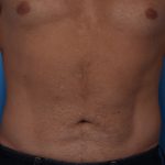 Liposuction Before & After Patient #5469