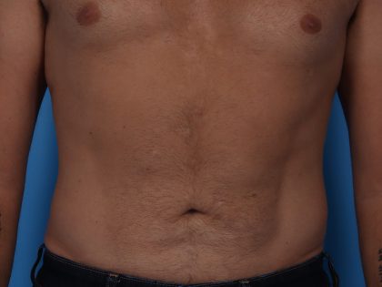 Liposuction Before & After Patient #5469