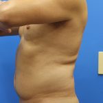 Liposuction Before & After Patient #5469