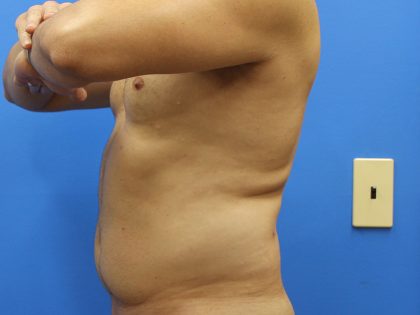 Liposuction Before & After Patient #5469