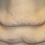 Tummy Tuck Before & After Patient #5536