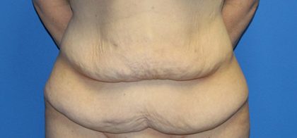 Tummy Tuck Before & After Patient #5536