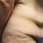 Tummy Tuck Before & After Patient #5536