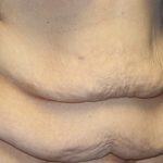 Tummy Tuck Before & After Patient #5536