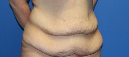 Tummy Tuck Before & After Patient #5536