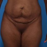 Tummy Tuck Before & After Patient #5543