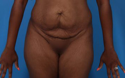 Tummy Tuck Before & After Patient #5543