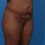 Tummy Tuck Before & After Patient #5543