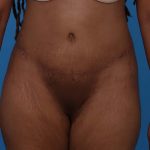 Tummy Tuck Before & After Patient #5543