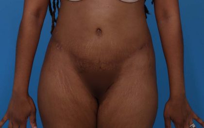 Tummy Tuck Before & After Patient #5543