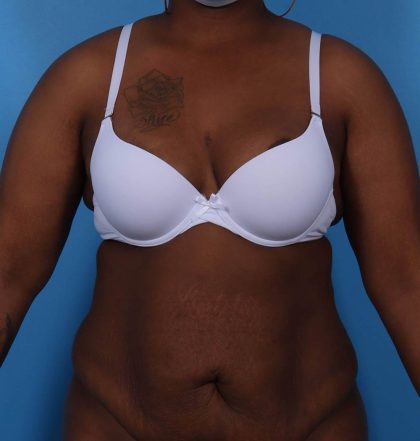 Tummy Tuck Before & After Patient #5691