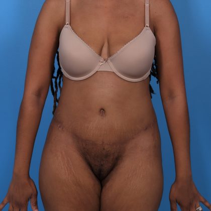 Tummy Tuck Before & After Patient #5740