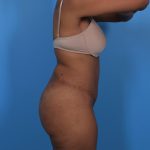 Tummy Tuck Before & After Patient #5740