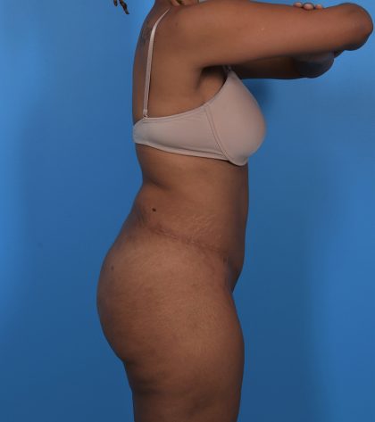 Tummy Tuck Before & After Patient #5740