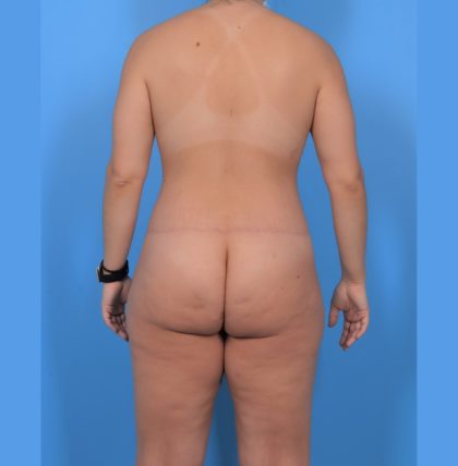 Tummy Tuck Before & After Patient #5779