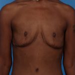 Fat Transfer to Breast Before & After Patient #6197