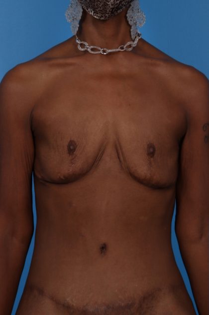 Fat Transfer to Breast Before & After Patient #6197