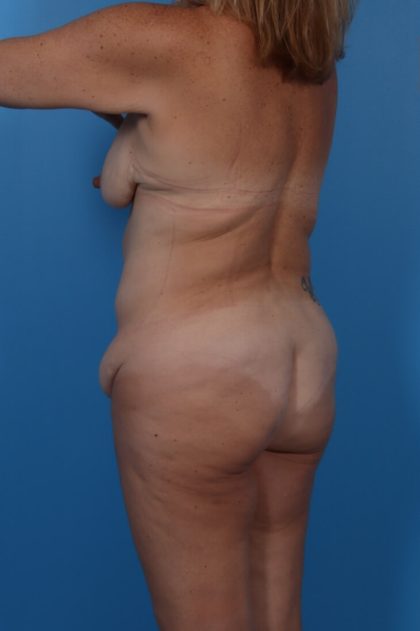 Breast Lift Before & After Patient #6198