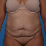 Tummy Tuck Before & After Patient #6162