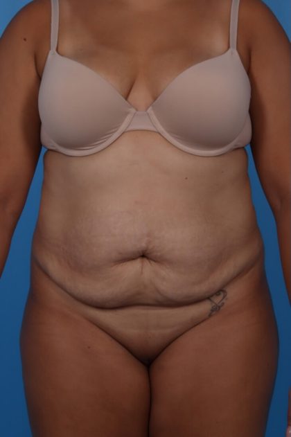 Tummy Tuck Before & After Patient #6162