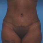 Extended Tummy Tuck Before & After Patient #6163