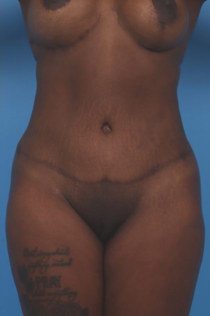 Extended Tummy Tuck Before & After Patient #6163