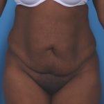 Extended Tummy Tuck Before & After Patient #6163