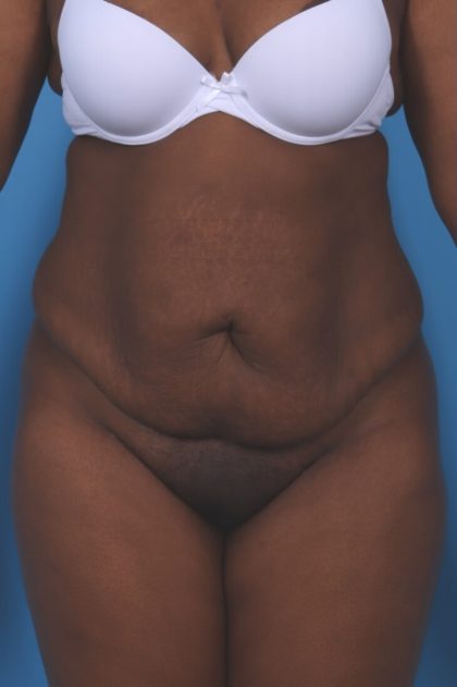 Extended Tummy Tuck Rockville, Maryland & Northern Virginia