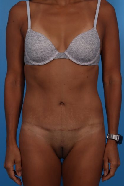 Tummy Tuck Before & After Patient #6182