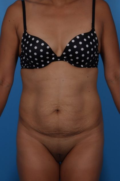 Tummy Tuck Before & After Patient #6182