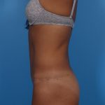Tummy Tuck Before & After Patient #6182