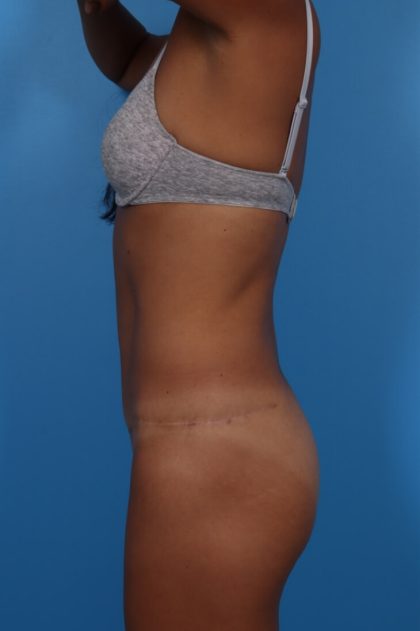 Tummy Tuck Before & After Patient #6182