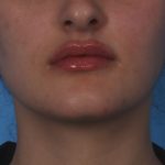 Lip Enhancement Before & After Patient #6207