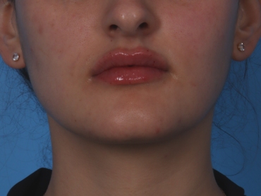 Lip Enhancement Before & After Patient #6207