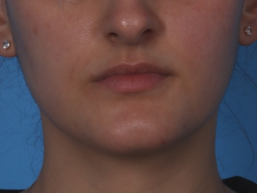 Lip Enhancement Before & After Patient #6207