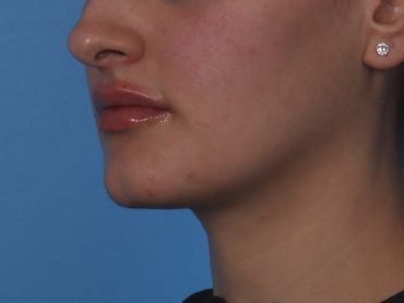 Lip Enhancement Before & After Patient #6207