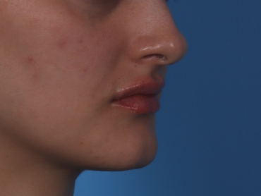 Lip Enhancement Before & After Patient #6207