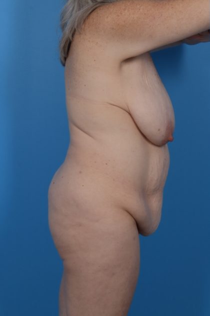 Breast Augmentation Before & After Patient #6282
