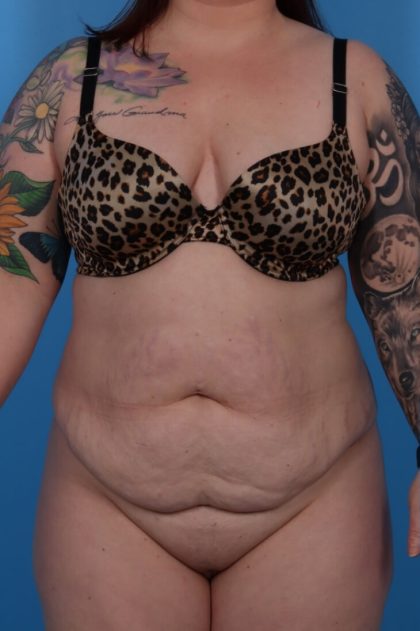 Extended Tummy Tuck Before & After Patient #6290